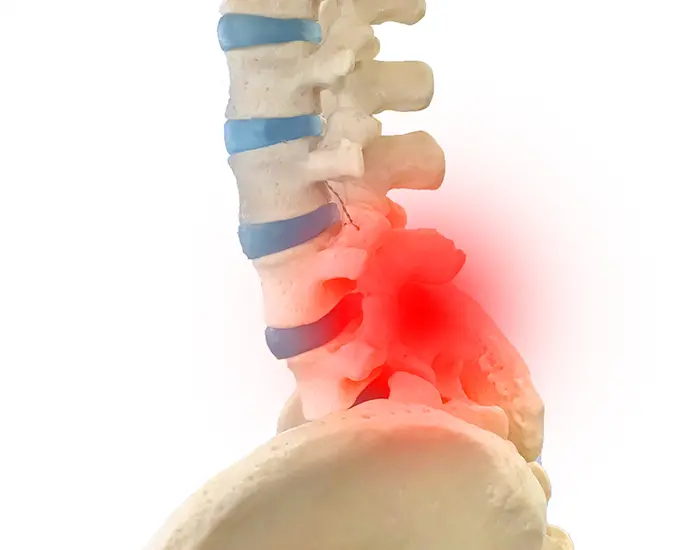 腰椎椎間板ヘルニアのイメージ